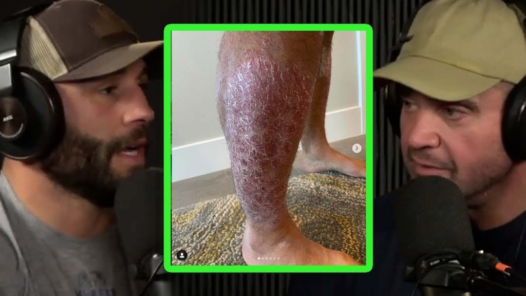 Picture of: Chad Mendes Used Carnivore Diet to Heal Psoriasis