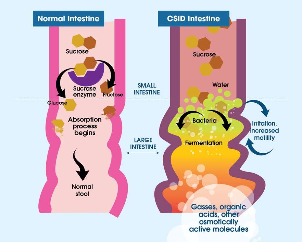 Picture of: CSID: How To Manage Sucrase-Isomaltase Deficiency