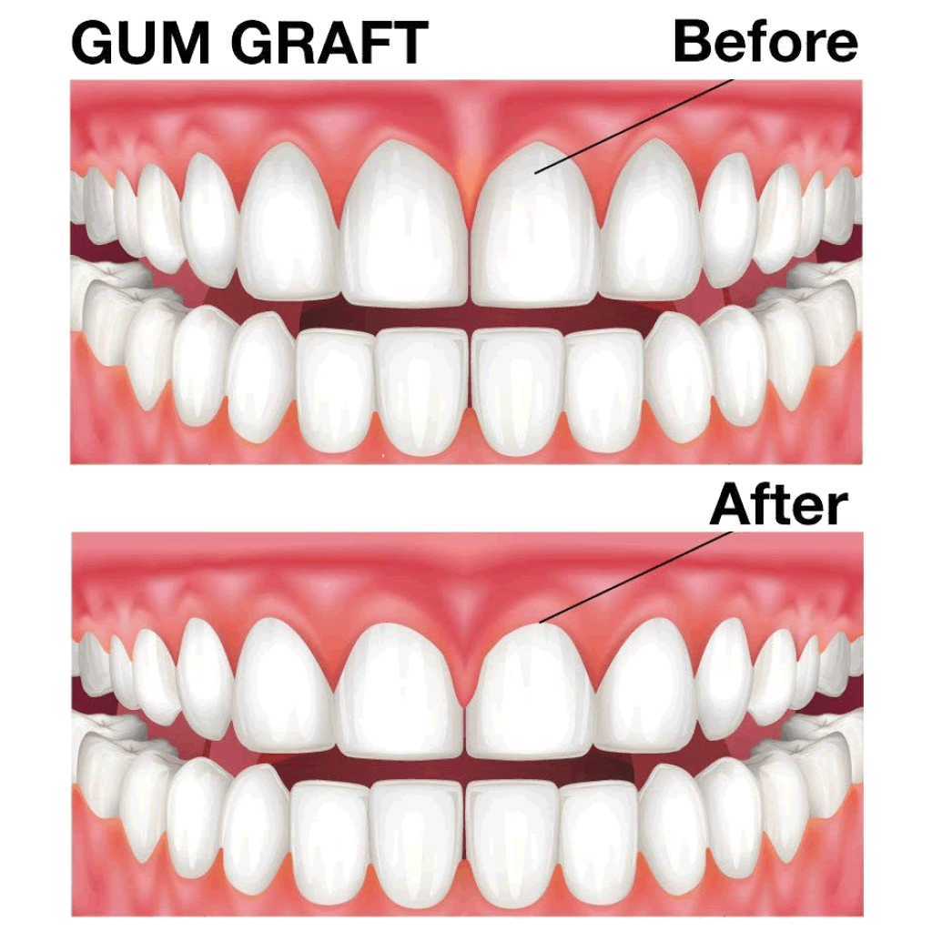Picture of: Dental Do’s and Don’ts After Gum Graft Surgery – Tucson Periodontist